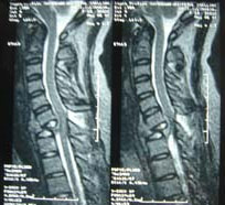 meniscus repair